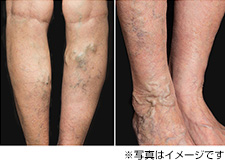 足のむくみに注意 下肢静脈瘤 今月の健康コラム 一般社団法人 千葉市医師会