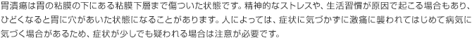 胃潰瘍は胃の粘膜の下にある粘膜下層まで傷ついた状態です。精神的なストレスや、生活習慣が原因で起こる場合もあり、ひどくなると胃に穴があいた状態になることがあります。人によっては、症状に気づかずに激痛に襲われてはじめて病気に気づく場合があるため、症状が少しでも疑われる場合は注意が必要です。